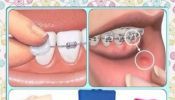 Cera Dental Protectora Brackets Pieza De Mano Ortodoncia Blanqueamiento Odontologia Ceras Protectora Labio Diente
